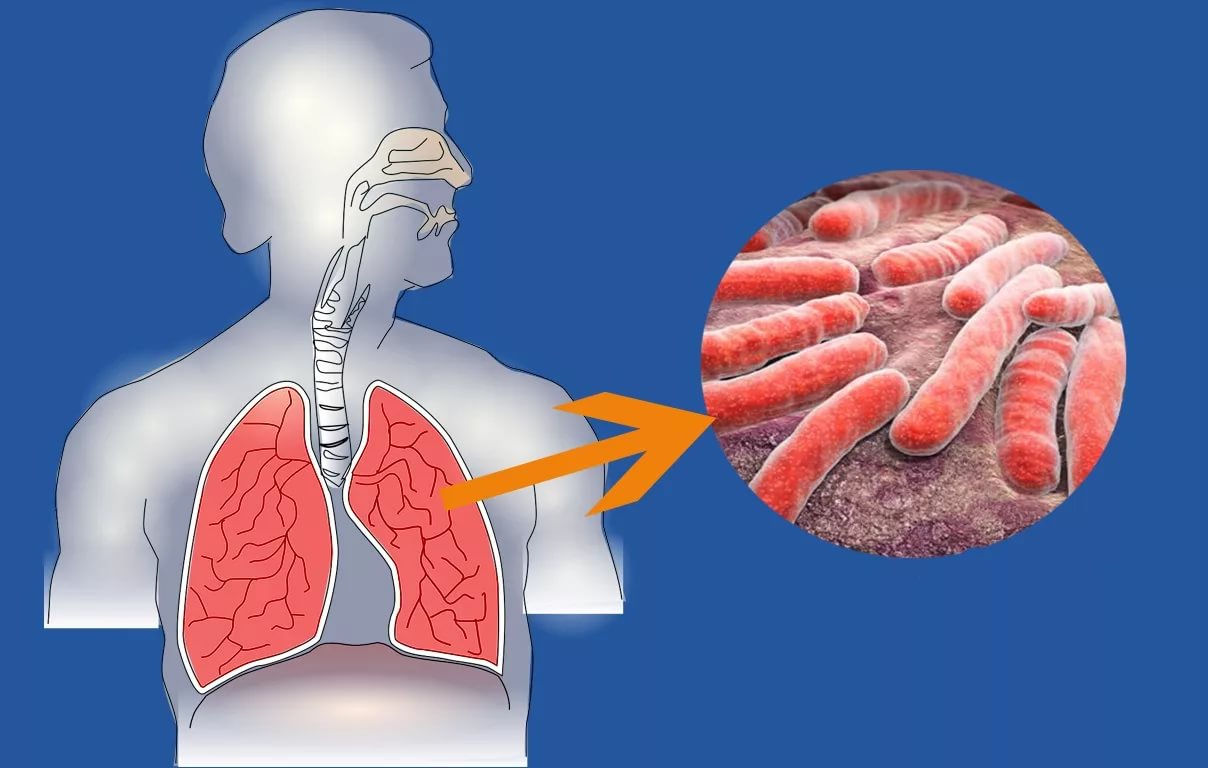  Как уберечься от туберкулеза 