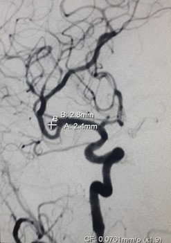   Рентгенэндоваскулярная эмболизация аневризмы сосудов головного мозга.  